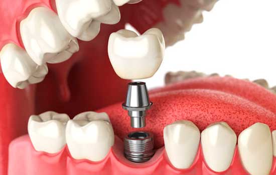 implante dentário