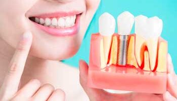 implante dentário grátis