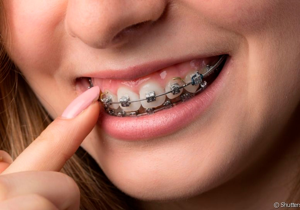 aparelho dental grátis